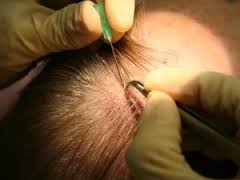 FUE Hair Transplant Technique