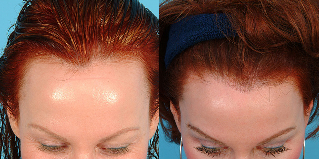 Receding Hairline Treatment Hair Regrowth Layton UT