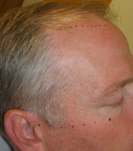 Frontal Hair Line Restoration