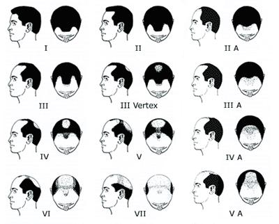 Common Male Baldness Patterns