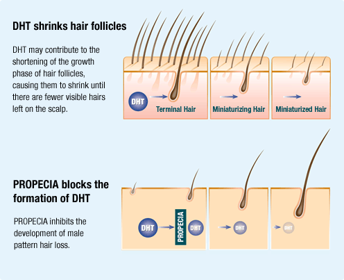 Effects of DHT on Hair Loss