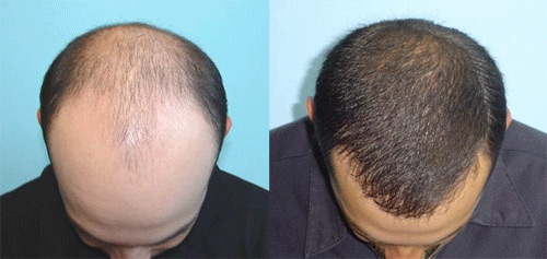 Hair Transplant B/A photos