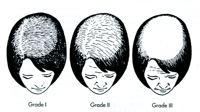 women-hair-loss-utah