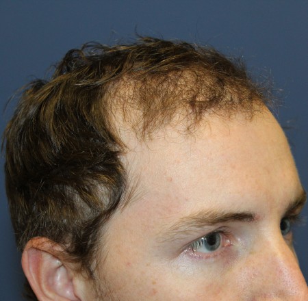 hair transplant 1567 prp session treatment close views
